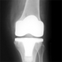 Endoprosthesis of the knee joint - TEP of the knee joint