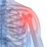 Frozen shoulder - how to treat it modernly and faster?
