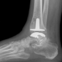 Endoprosthesis of the ankle joint - TEP of the ankle