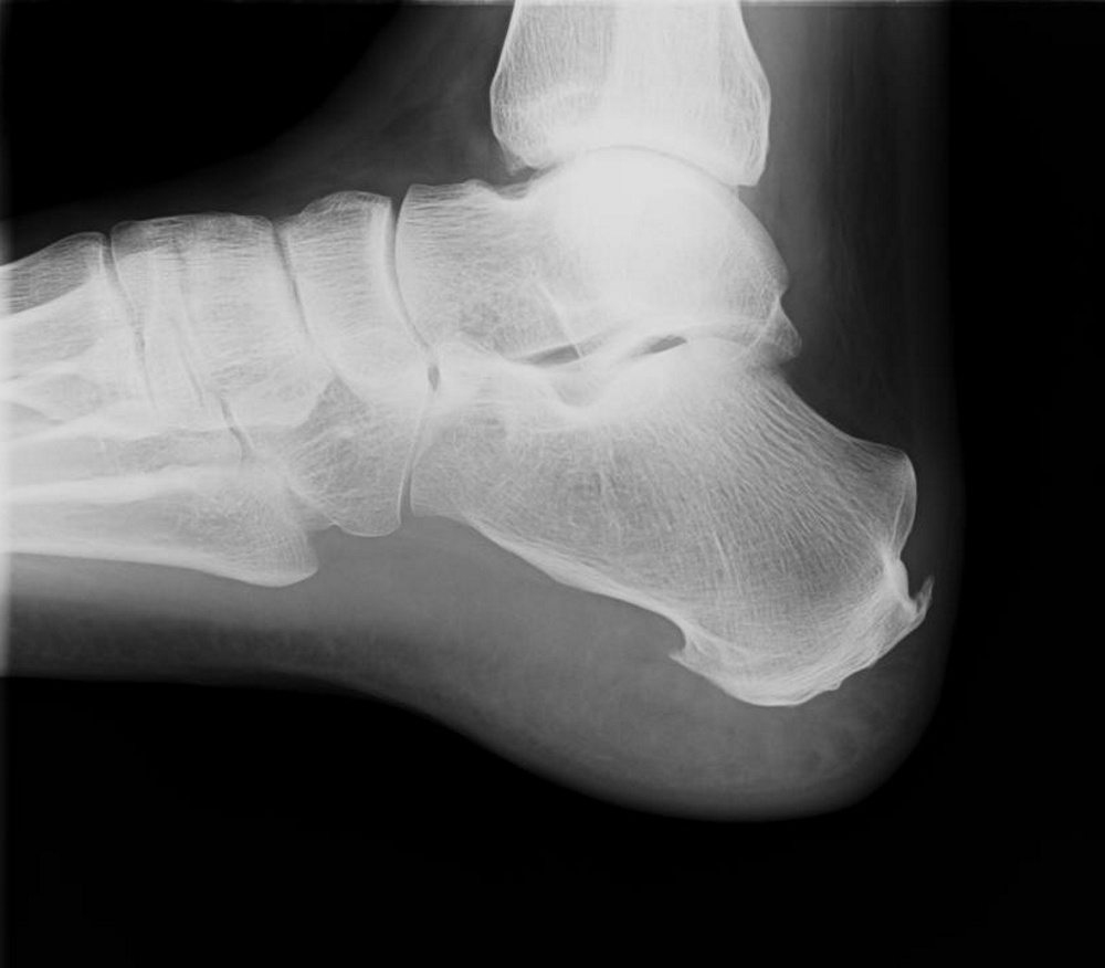 saddle bone deformity flat feet