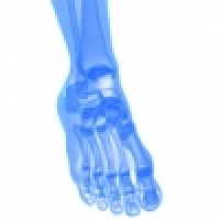 How does a bunion develop and what are the options of treatment