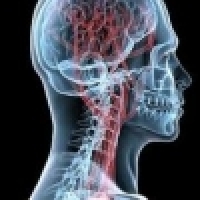 Vertigo during head bend - Vertebrobasilar insufficiency