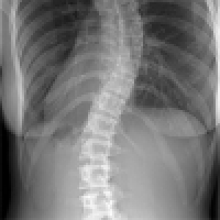 Conservative treatment and modern physiotherapy of scoliosis in children’s age.